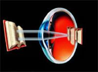Hyperopia or Farsightedness Eye