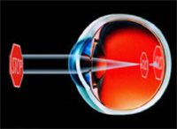 Myopia Surgery Nearsightedness