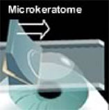 Microkeratome Blade Eye Surgery