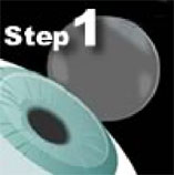 LASIK Technology Step 1 - Creating the Flap