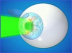 Laser Eye Surgery Procedure Step 2